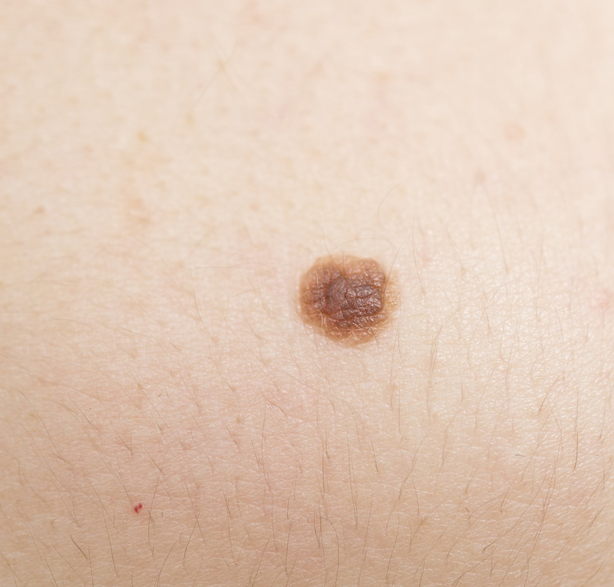 Non-invasive diagnosis of melanoma - Sun is Life